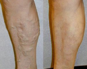 blockage of veins on the legs