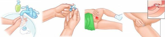 Rektális kúpok Hemoprotekt: részletes használati utasítás