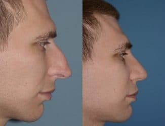 laser septoplasty before and after the procedure