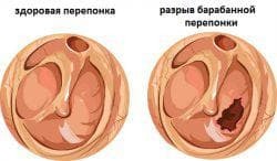 rupture of the eardrum