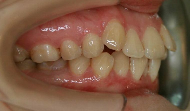 Retrusion ir išstūmimas - ką daryti, jei burnoje yra dantys - "atsistoja" ir "atsikėlė"