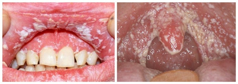 Candidoza din gură - simptome și fotografii