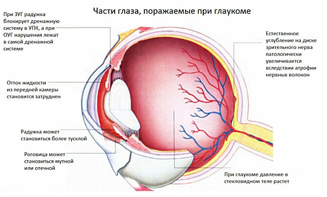 Taflotan - tehokas lääke glaukooman hoitoon
