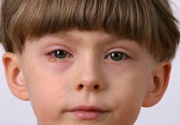 How to quickly cure conjunctivitis in children