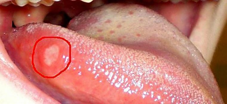 Spots i tungen som en indikator på lidelser i kroppen