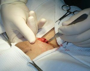 revascularisation microchirurgicale du testicule