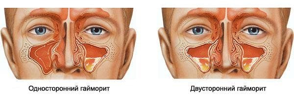 Manifestation of various forms of sinusitis
