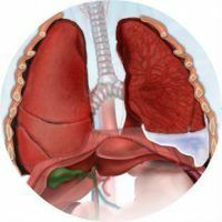 Fluide dans les poumons - les causes de l'apparence, le diagnostic et le traitement