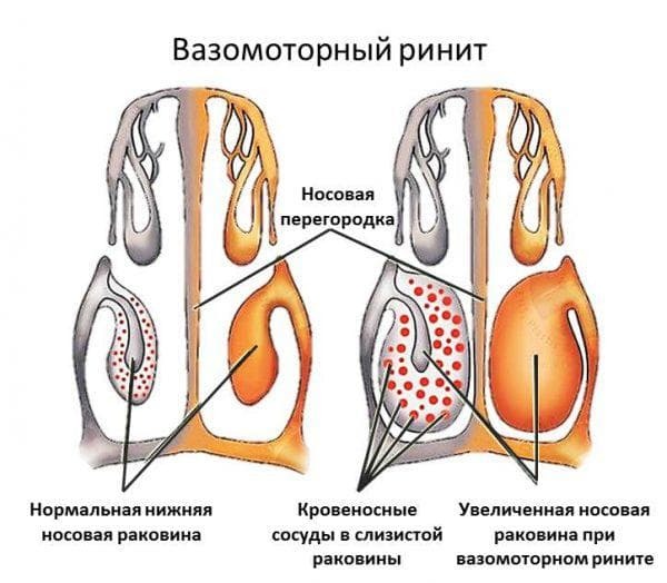rinita vasomotorie