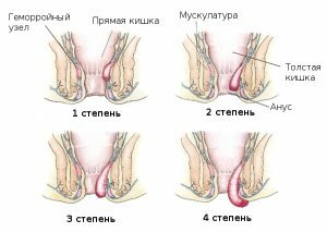 Pros and Cons of Sclerotherapy of Hemorrhoids: Testimonials and Tips