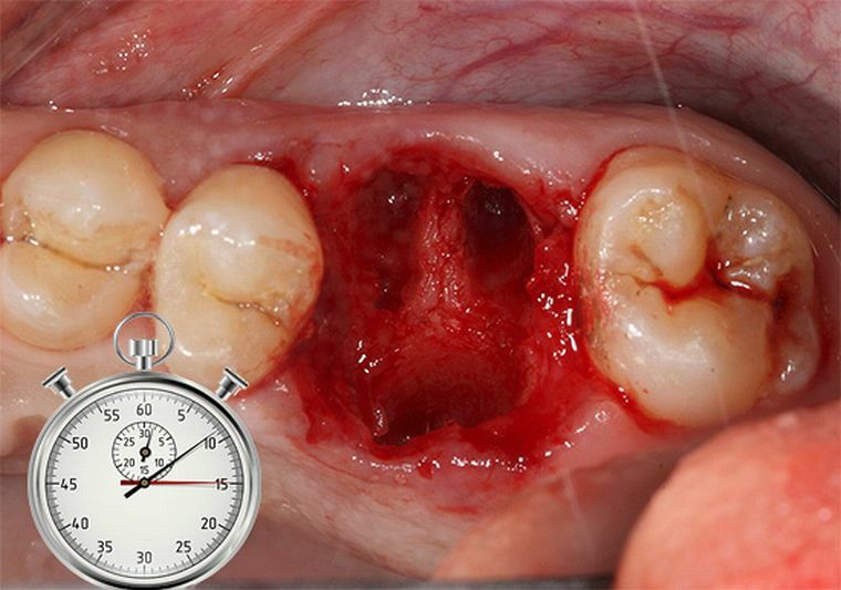 Alveolitis gaten na tandextractie - een klein probleem of een formidabele complicatie?