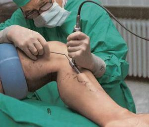 Striping met spataderen is een mini-invasieve methode voor de behandeling van een ziekte