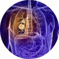 Bronchito tipai, jo priežastys, simptomai, diagnozė ir gydymas