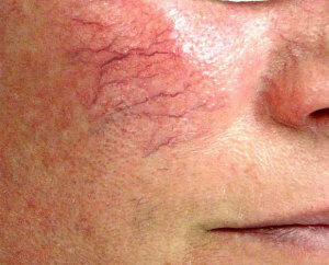 How to safely and permanently remove the vascular asterisks on the face