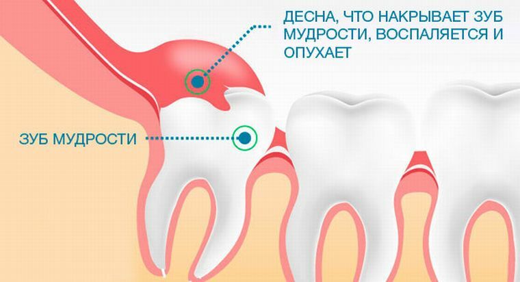 Cosa si può fare se il dente del giudizio fa male: come alleviare l'infiammazione e il dolore?