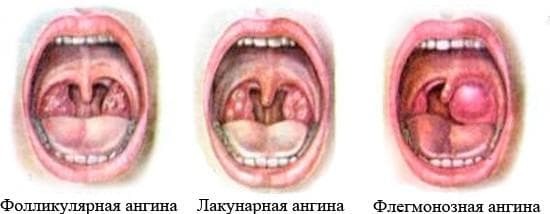 forms of sore throat