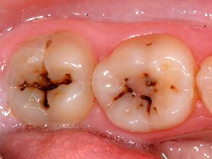 En cyste på en tand: hvad er det, symptomer, fotos, behandling og konsekvenser