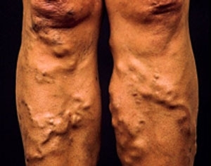 phlebitis של הרגליים