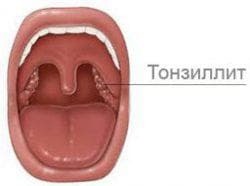 chronic tonsillitis