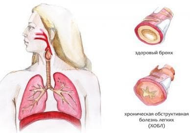 Chronical bronchitis