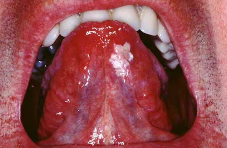 Leukoplakie der Mundhöhle: nur einen Steinwurf von Krebs entfernt