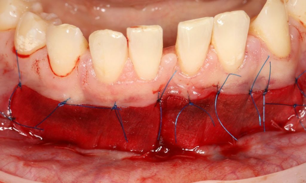 Plastische chirurgie van de mondholte: technologie en werkwijzen