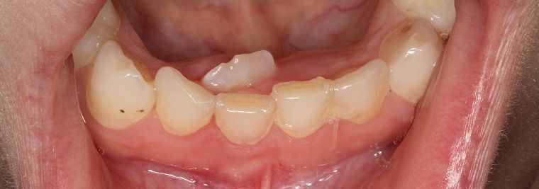 Tänderna växer i två rader - "hajkäken" i våra barns mun