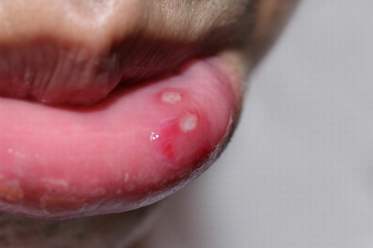 Hvorfor vises sår i munden og hvordan man kan helbrede såret?