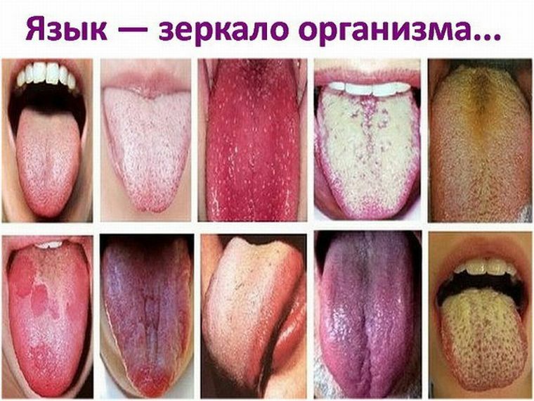 Le cause che causano gonfiore della lingua: cosa succede se è gonfio?