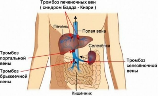 Kompleksiteter af diagnose og behandling af portveve trombose