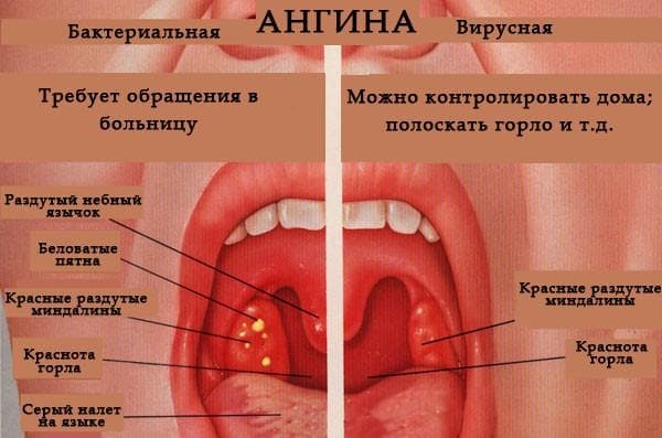 Is sore throat, contagious or not?