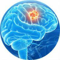 Znaki možganske kapi pri moških in ženskah, prva pomoč in zdravljenje