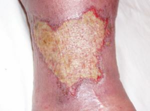 úlcera trófica na perna