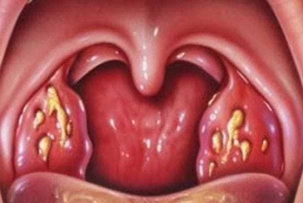 How to treat a white scurf on the baby's tonsils