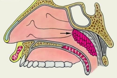 Forming green mucus in the nasopharynx