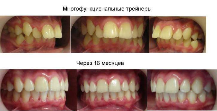 Doel en kenmerken van het gebruik van trainers voor tanden