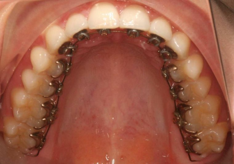 Estetinės petnešos - ką siūlo modernūs ortodontai