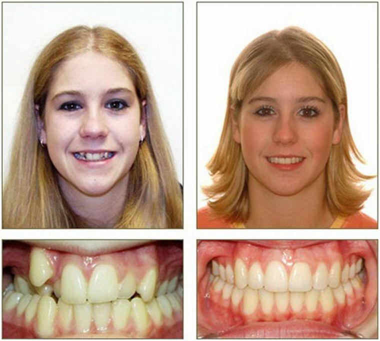 Kui on vaja korrigeerida hammusid kirurgiliselt - operatsiooni sammud