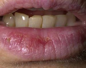 Kreft, avgjort i munnen: årsakene til og behandlingen av svulster