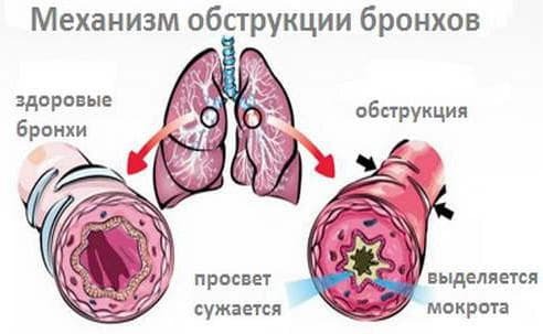 Bronchitis obstructive