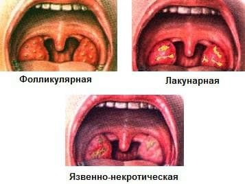 Ulcerative necrotic tonsillitis
