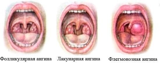 types of sore throat