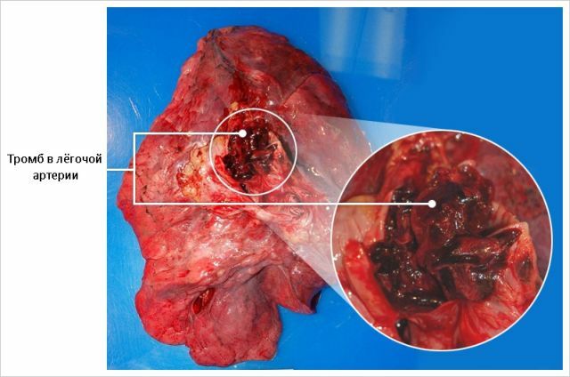 A pulmonáris artéria thromboembolia: elsősegélynyújtás és tüdőembólia kezelés