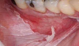 How to deal with thermal and chemical burns of the oral mucosa?