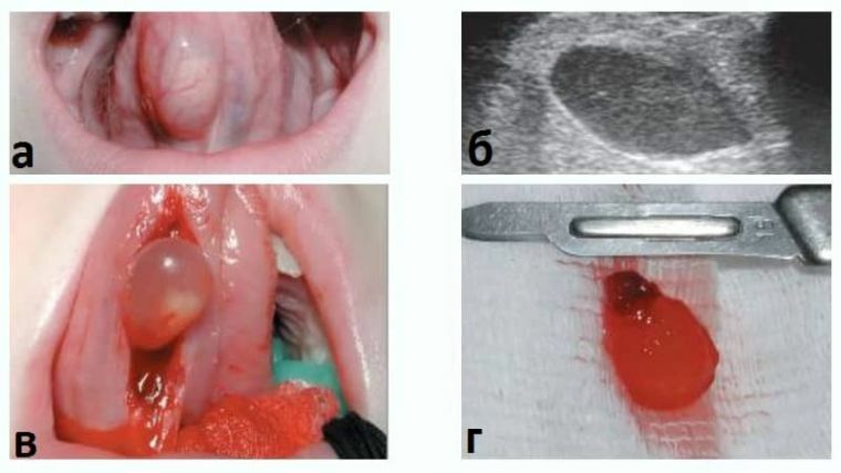 Timely detection and treatment of salivary gland cysts
