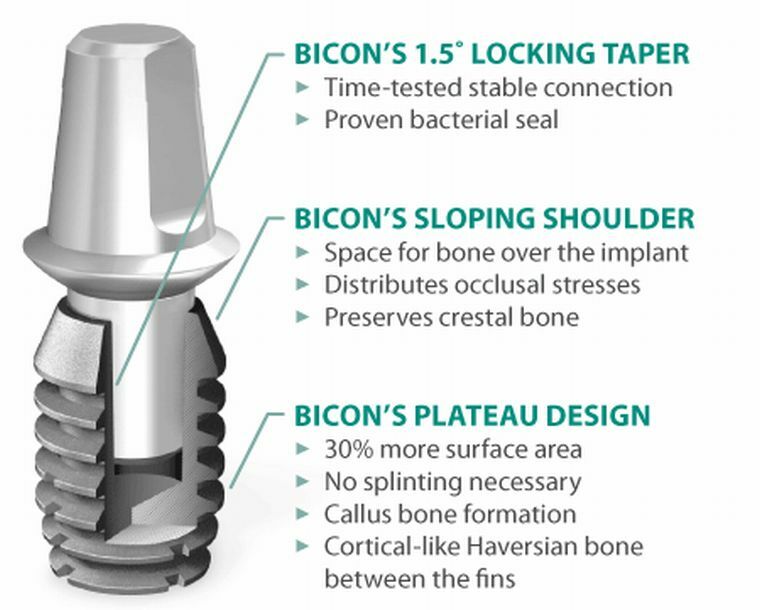 Variedad de soluciones y ventajas de los implantes Bicon