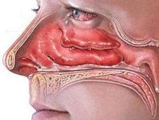 nosies gleivinės edema