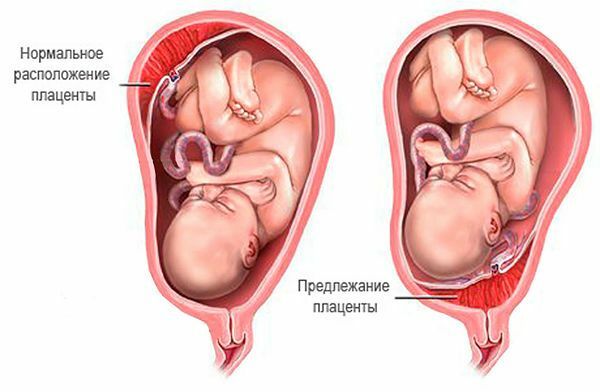 Ceea ce este periculos este placenta previa în timpul sarcinii