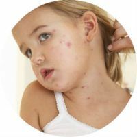 Dermatitis alergi: penyebab, gejala, pengobatan