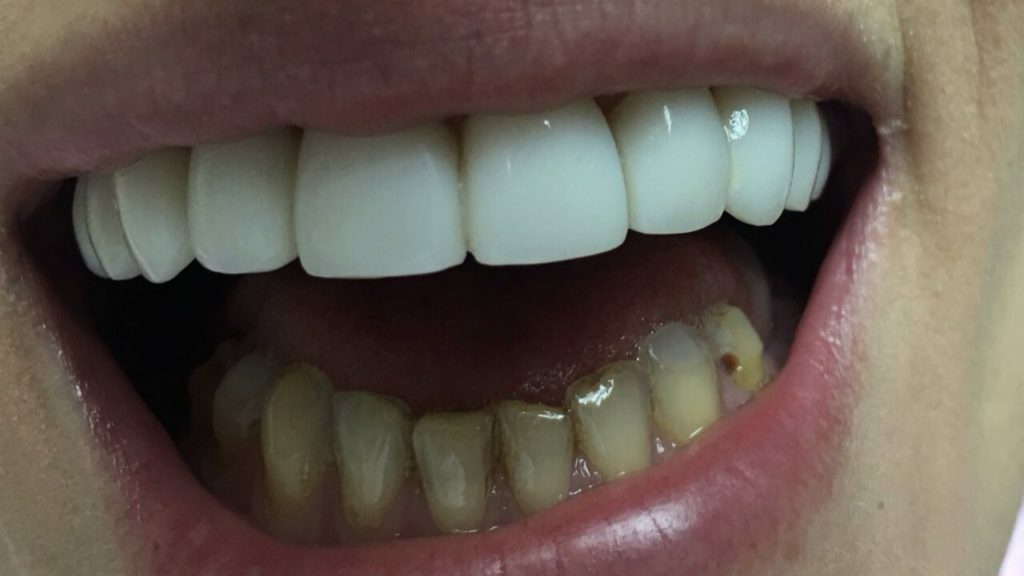 Metodi efficaci per il ripristino dei denti